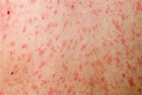 Primeros Casos de Sarampión en Menores