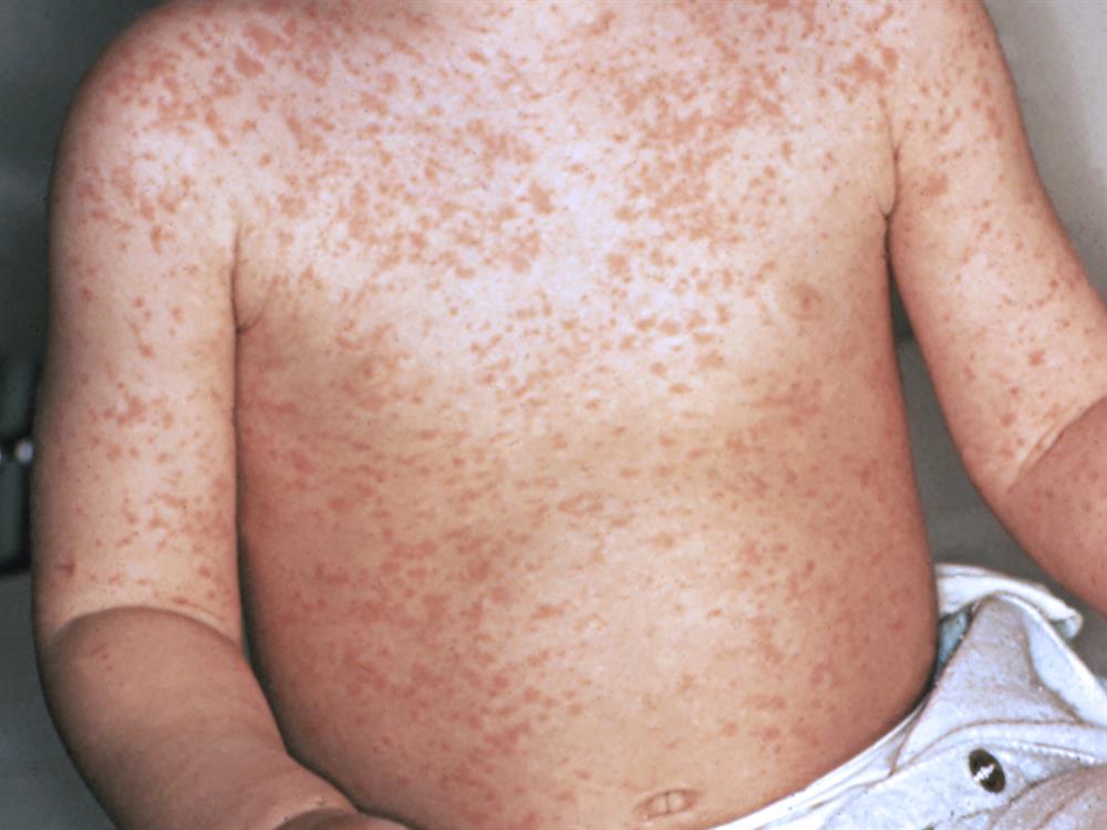 Veracruz Confirma 25 Casos de Sarampión en 2026