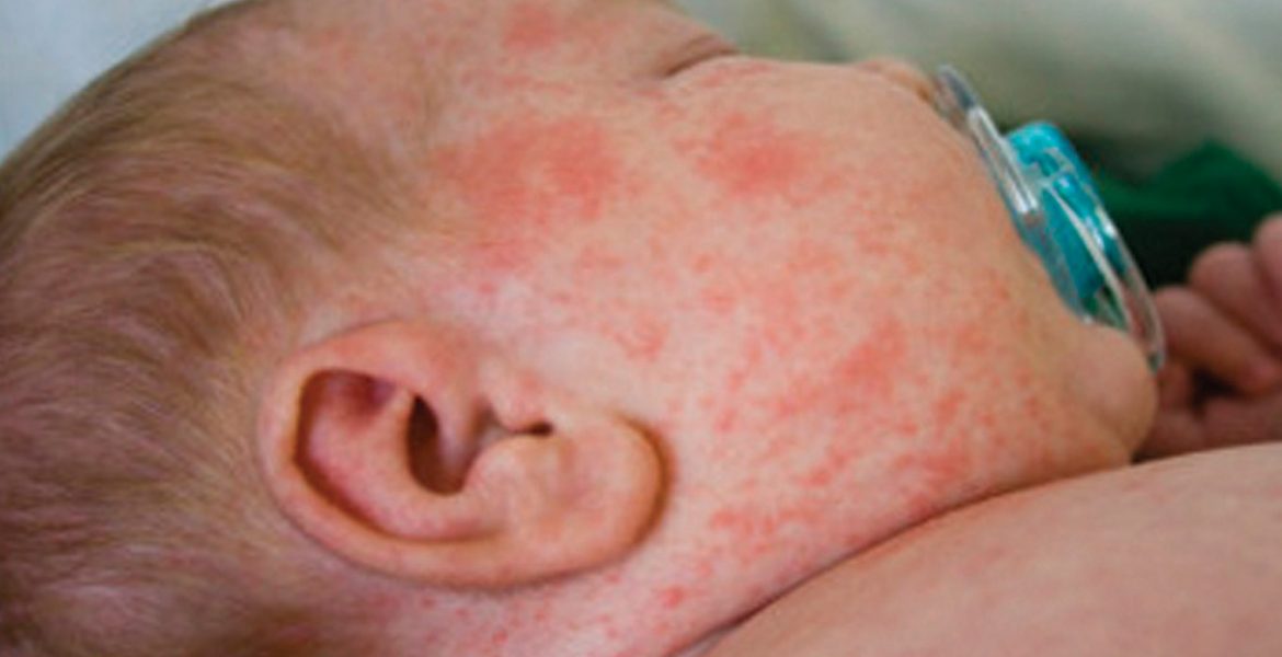 Avanza con Éxito la Estrategia Nacional de Atención al Sarampión